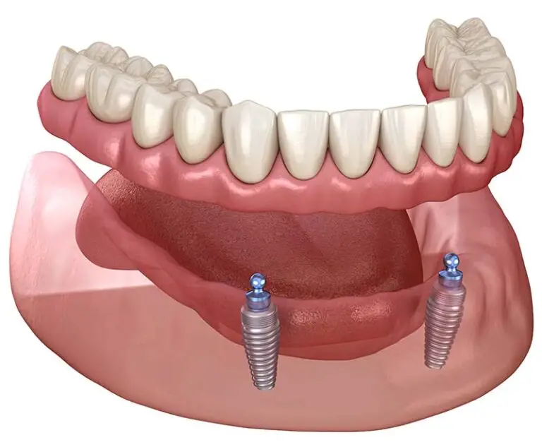 Soorten klikgebit: welke constructie past bij u? klikgebit op implantaten